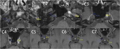 Vascular Diameters as Predictive Factors of Recanalization Surgery Outcomes in Internal Carotid Artery Occlusion